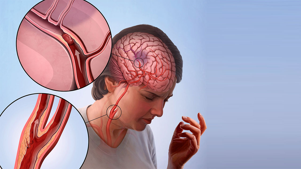 İnmeden sonraki ilk 3 saatin tedavinin başarısı açısından kritik olduğu belirtildi